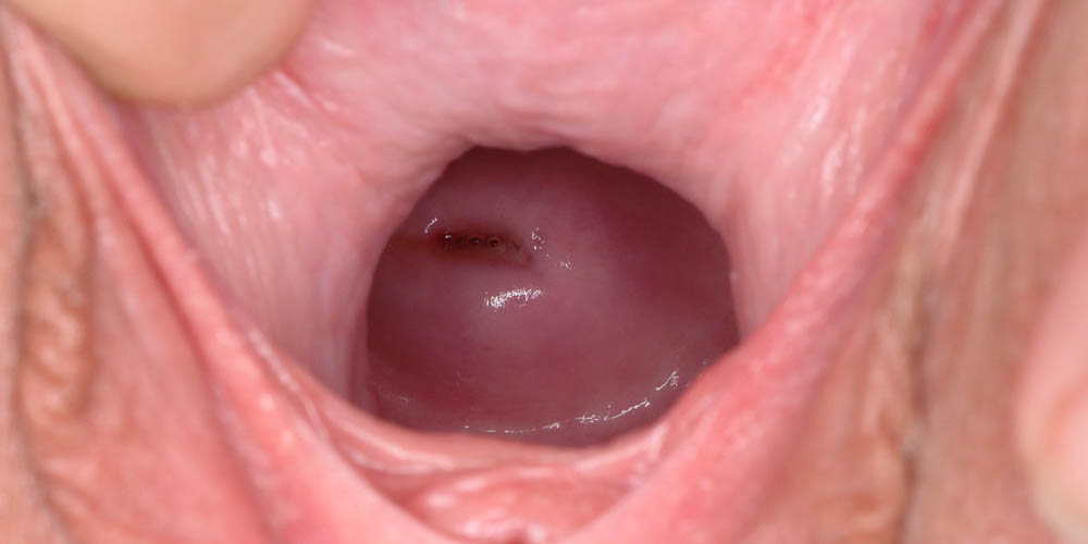 Pure Gaping